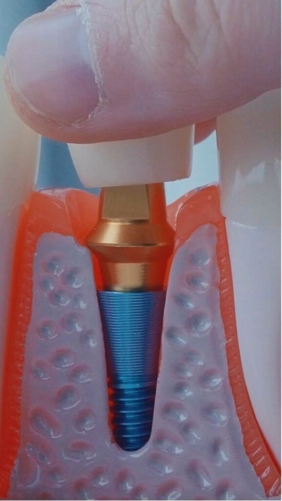 How Long Dental Implants Last