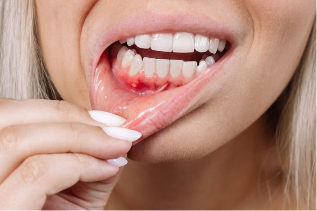 Can You Have Dental Implants with Gum Disease?