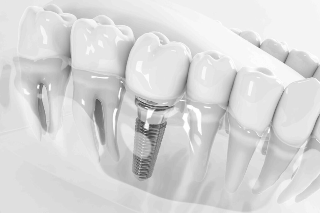 Dental Implant and Allergies