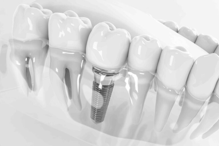 Dental Implant and Allergies